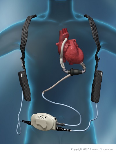 植込み型補助人工心臓HeartMateⅡの写真