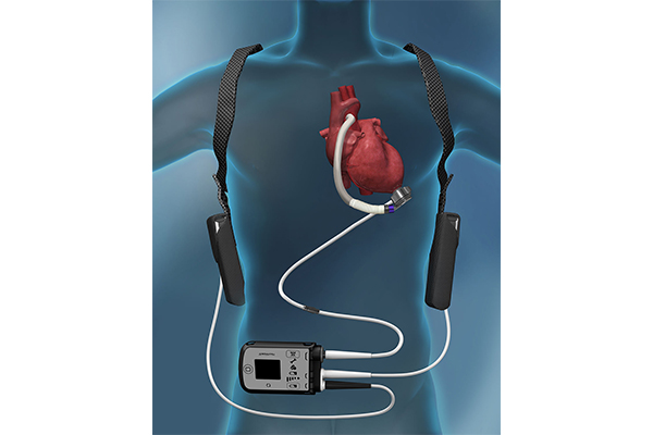 植込み型補助人工心臓　HeartMate3の写真